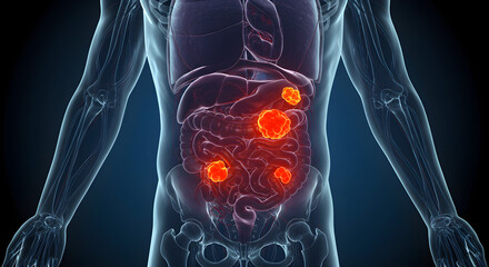 Abdominal Cancer Growth and Spread Visualization