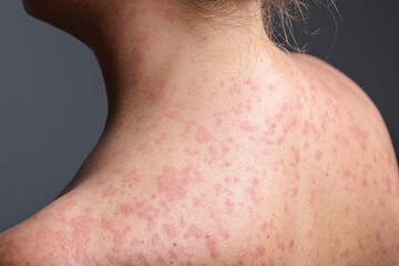 A woman with a red, spotty rash caused by measles.