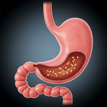  stomach showing signs of Gastroparesis, with food particles visibly lingering inside the stomach due to delayed emptying. The stomach appears slightly distended, and the pyloric sphincter (exit to sm