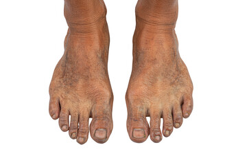 Close-up view of two dirty, weathered feet