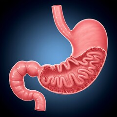 stomach exhibiting signs of Menetrier's Disease (hypertrophic gastropathy). The internal lining (mucosa) is shown with abnormally enlarged folds and visible protein loss, giving it a convoluted, thick