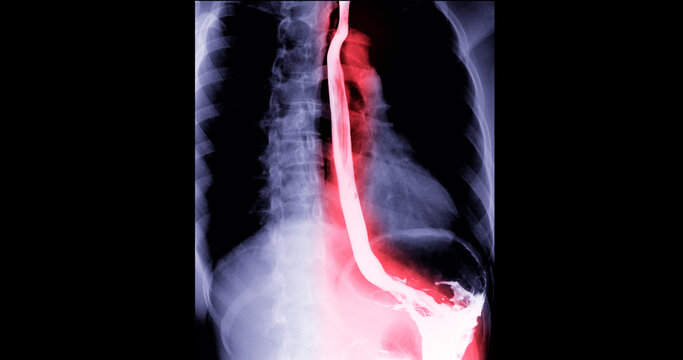 Fluoroscopic footage of a barium swallow test showing real-time esophageal function, used to assess dysphagia, GERD, and structural abnormalities.