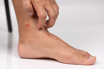 Close up view of flea bites on lower legs and feet skin.