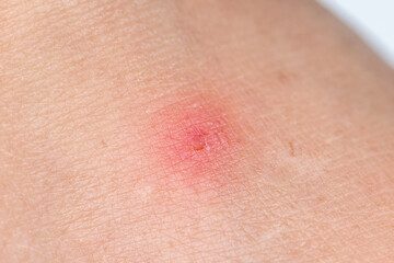 Close up view of flea bites on lower legs and feet skin.