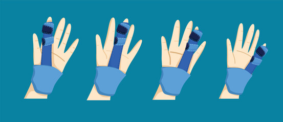 Broken Finger Treatment with Splint and Bandage in Medical Care

