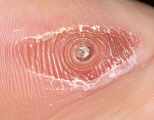 Fototapeta premium close-up of a human foot with a painful plantar corn, realistic medical photograph