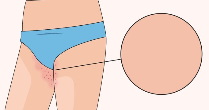 Animation dermatitis disease explanation