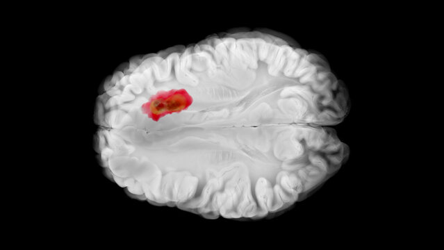 Axial view of the brain showing a glioblastoma in the left frontal lobe with central necrosis, peripheral infiltration, and early midline shift.
