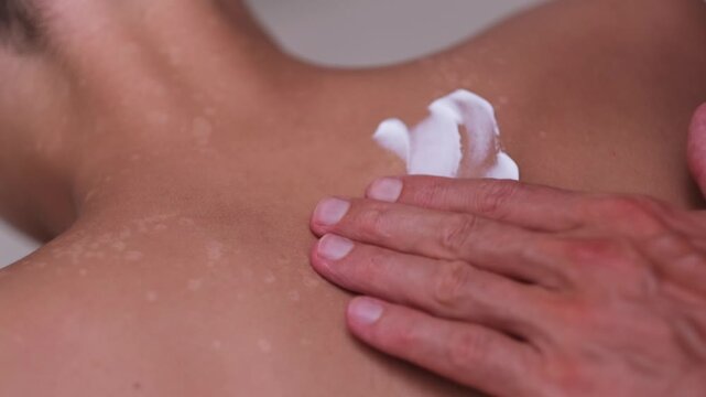 A man's hand applying medical ointment to the back of a teenager with a fungal skin disease.