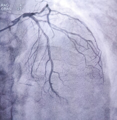 Coronary angiogram of left coronary artery during cardiac catheterization with contrast dye. Abnormal findings. Colour adjust.