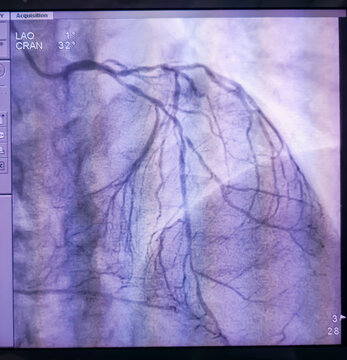 Coronary angiogram of left coronary artery during cardiac catheterization with contrast dye. Abnormal findings. Colour adjust.