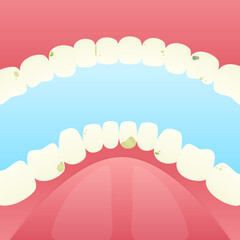 Flat Illustration of Human Teeth with Caries Problem, Dental Health. This flat illustration depicts a set of human teeth affected by caries. 