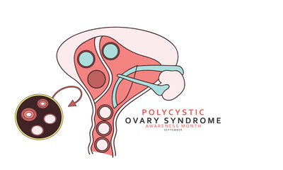 Polycystic Ovary Syndrome Awareness Month, Concept Design Background.