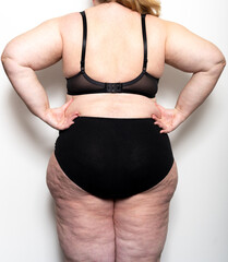 Frau zeigt ihre Cellulite, Thema Abnehmen und Diät