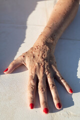 Hands of Female Patient with Neurofibromatosis