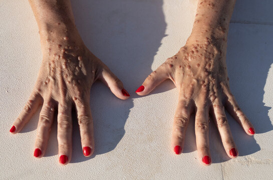Hands of Female Patient with Neurofibromatosis