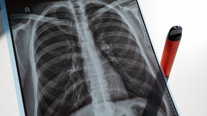 Disposable Vape and Lung X-Ray. 