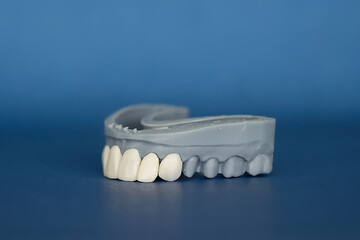 Blue dental cast of the upper jaw with veneers on teeth 1 to 3. Close-up on blue background. Concept of aesthetic restoration and cosmetic dental treatment. © Tatiana
