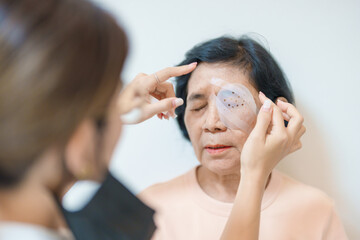Fototapeta premium Senior Woman during eye protecting by shield after eye surgery. Eye disease, Cataract, Glaucoma, Age Related Macular Degeneration, Diabetic Retinopathy, Vitreous, Lasik, World Glaucoma day and health