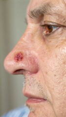 Close-Up of Basal Cell Carcinoma on Nose