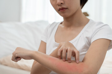skin problem and beauty. Young woman scratch body has itchy skin from skin allergic, steroid allergy, sensitive skin, red from sunburn, chemical allergy, rash, insect bites, Seborrheic Dermatitis.