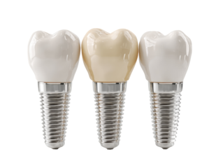 Three dental implants, one natural-colored, one light beige, one white