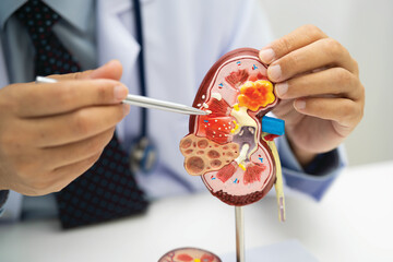 Kidney disease, Chronic kidney disease ckd, Doctor hold human model to treat and study in hospital.