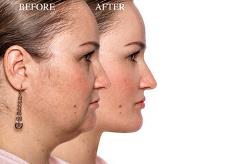 Chin Liposuction Before and After – Double Chin Reduction Results