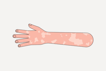 White vitiligo hand gesture, flat collage element vector