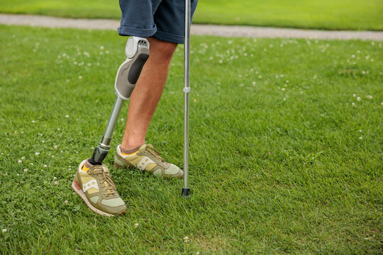 Man amputee with prosthetic leg disability on above knee transfemoral leg prosthesis artificial device outdoor. People with amputation disabilities everyday life.