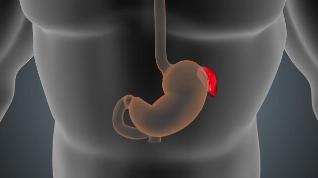 Splenectomy Spleen Removal Surgery Animation