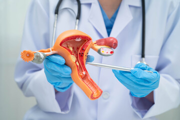 Uterus, doctor holding human anatomy model for study diagnosis and treatment in hospital.