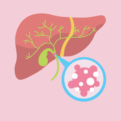 Minimalist vector illustration of bile duct cancer, showing key symptoms like jaundice, abdominal pain, and weight loss, with icons of similar diseases such as gallstones and hepatitis. liver 