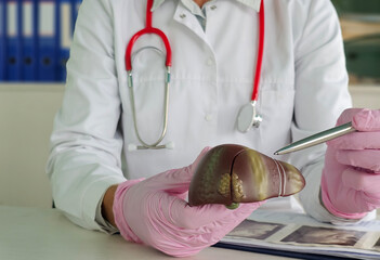 Medical professional examines anatomical liver model while discussing health and treatments in a...