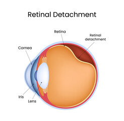 Retinal Detachment Illustration Eye Anatomy and Medical Condition