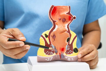 Asian doctor with rectum and hemorrhoid human anatomy model at hospital, inflamed vascular structure.