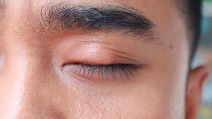 Close-up of a human eye with a swollen eyelid, possibly indicating a stye or infection, highlighting a common eye health issue.