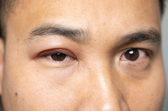A man with a swollen eyelid or edema, which can be caused by various factors such as allergies, infections, bed and insect bites or injuries