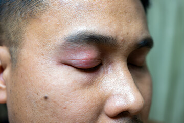 Obraz premium A man with a swollen eyelid or edema, which can be caused by various factors such as allergies, infections, bed and insect bites or injuries