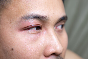 A man with a swollen eyelid or edema, which can be caused by various factors such as allergies,...