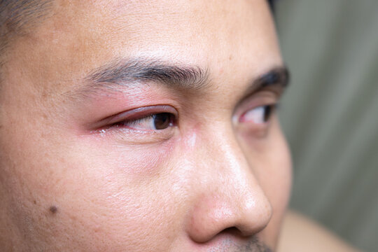 A man with a swollen eyelid or edema, which can be caused by various factors such as allergies, infections, bed and insect bites or injuries