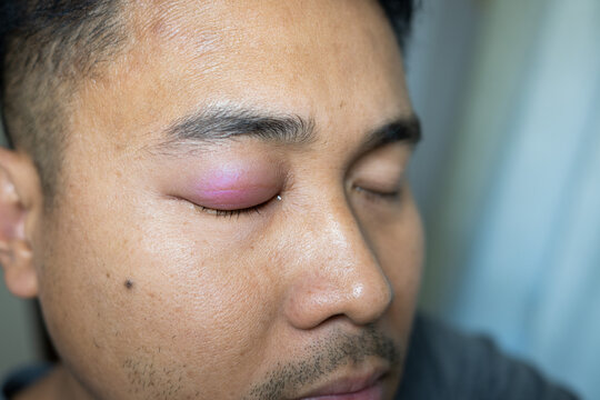 A man with a swollen eyelid or edema, which can be caused by various factors such as allergies, infections, bed and insect bites or injuries