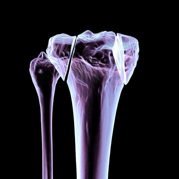 Tibia fracture Schatzker type V, 3D illustration