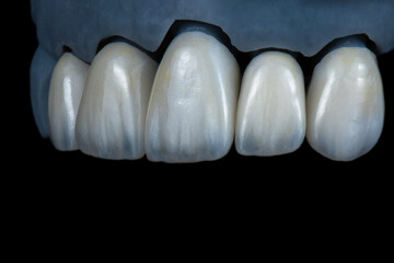 ceramic emax crowns and veneers bl4 color