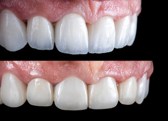 ceramic emax crowns and veneers bl4 color