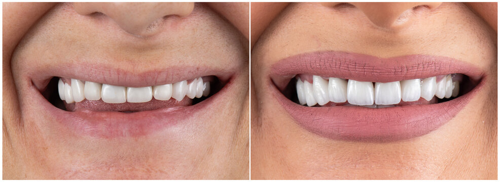 ceramic emax crowns and veneers bl4 color