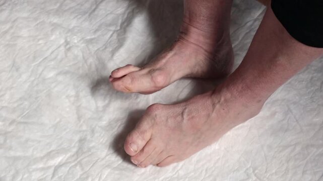 An elderly woman moves one foot with hallux valgus.