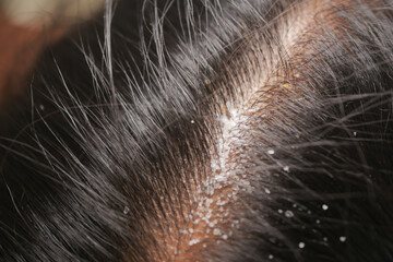 Scalp close-up showing dandruff and hair texture