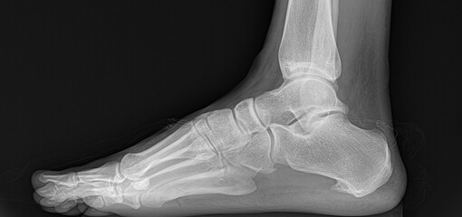 radiography of a foot with a clear example of a case of a heel spur.