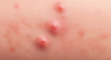 Fototapeta premium Chickenpox Blisters Skin Rash Medical Image